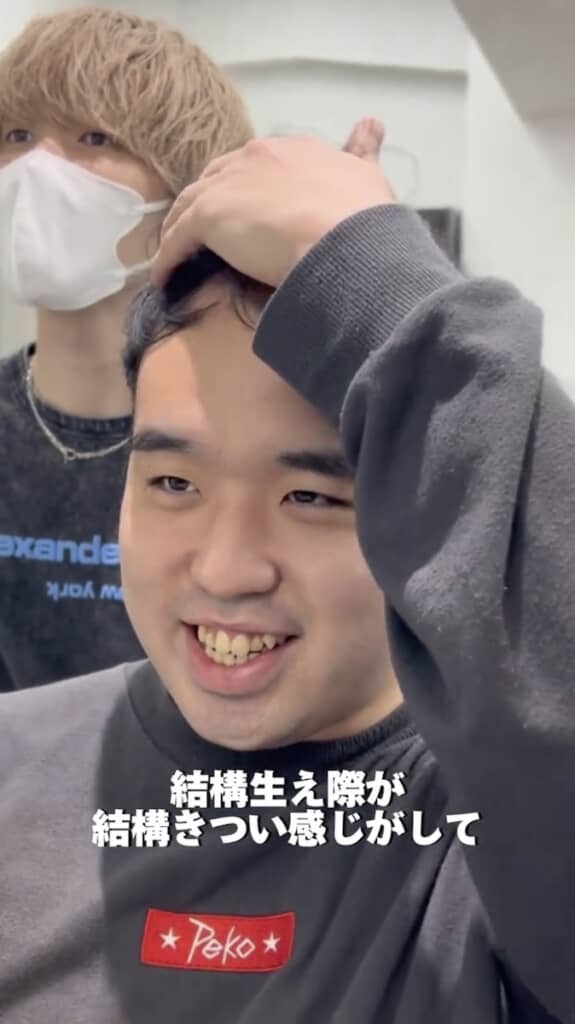 生え際に悩む男性