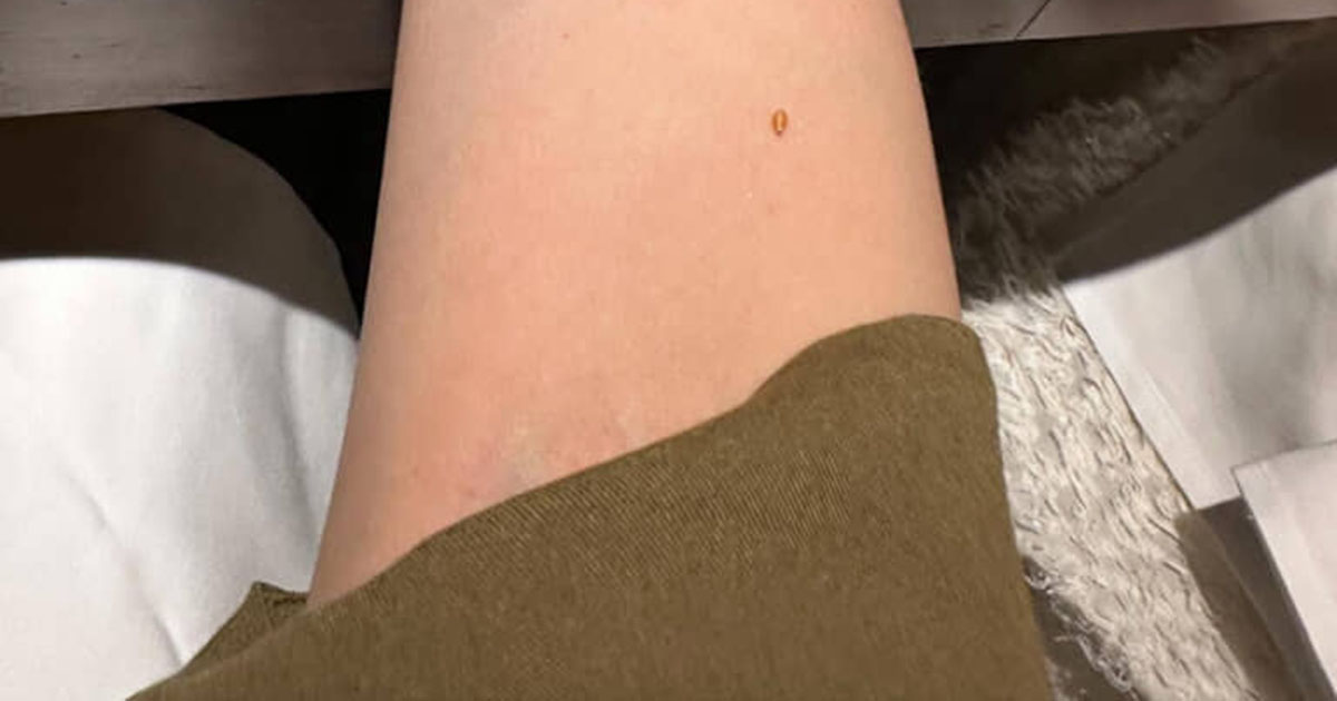 マダニに食われた!? →焦ってよく見たら……「まさかの！」　予想外すぎる正体に仰天　「めっちゃマダニに見える笑笑」（1/2） | ライフスタイル ねとらぼ