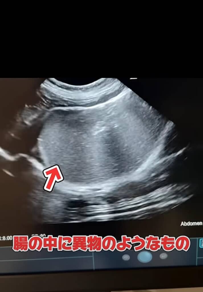 腸の中に異物を発見