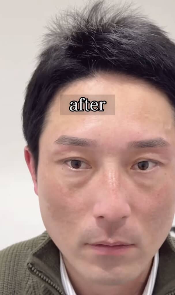 眉毛施術後の男性の顔アップ。“after”と表示され、眉が整っている。