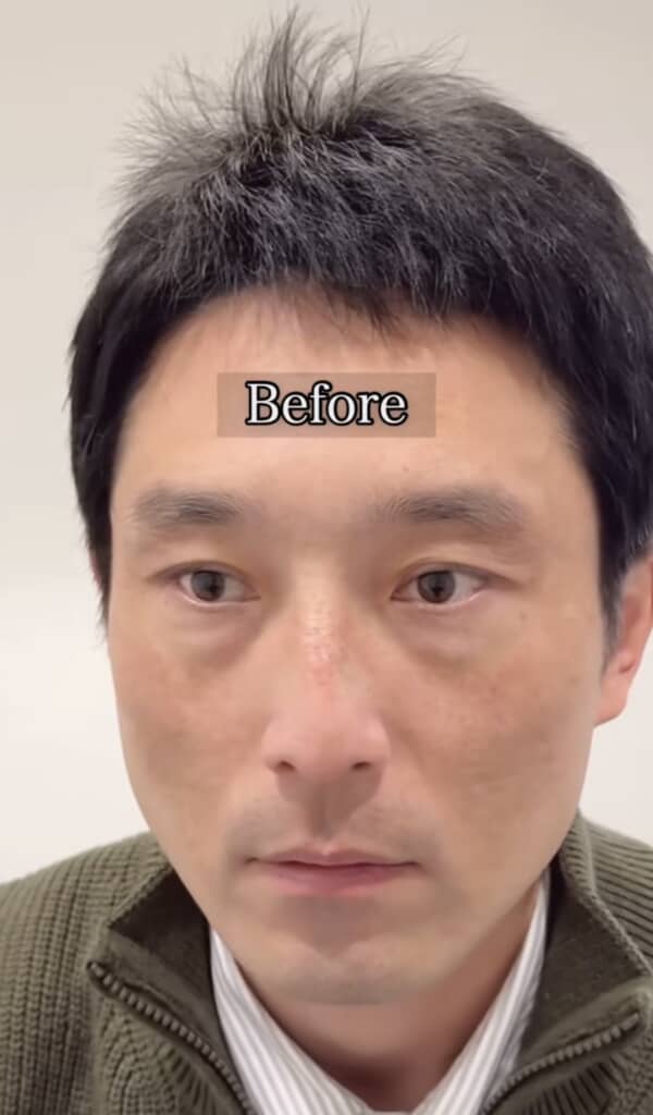 眉毛施術前の男性の顔アップ。“Before”と表示されている