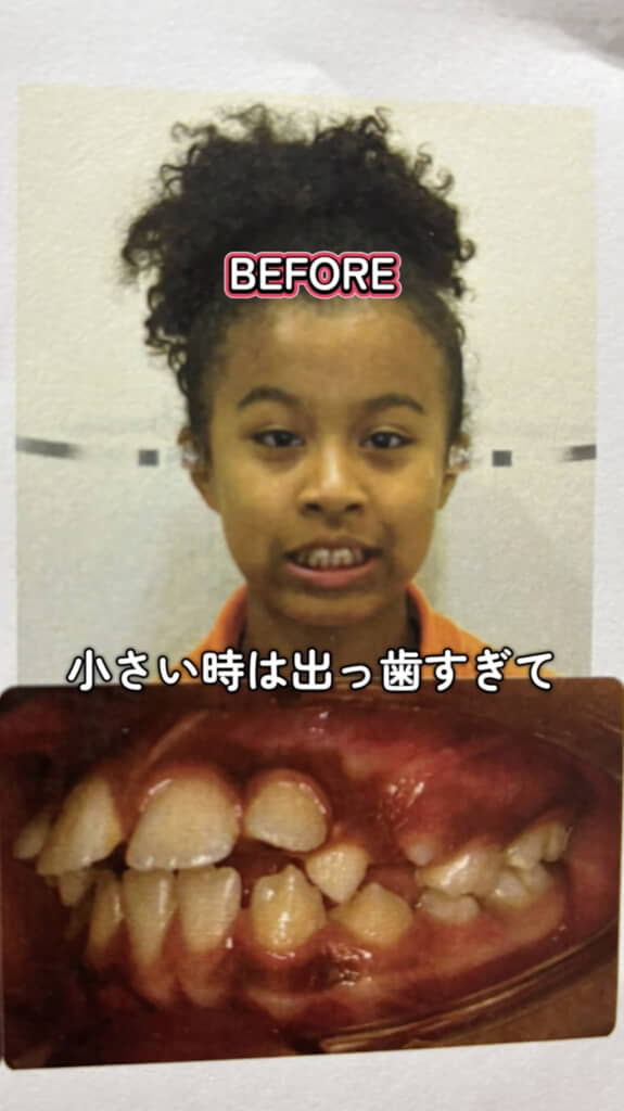 かなりの“出っ歯”だった子ども時代