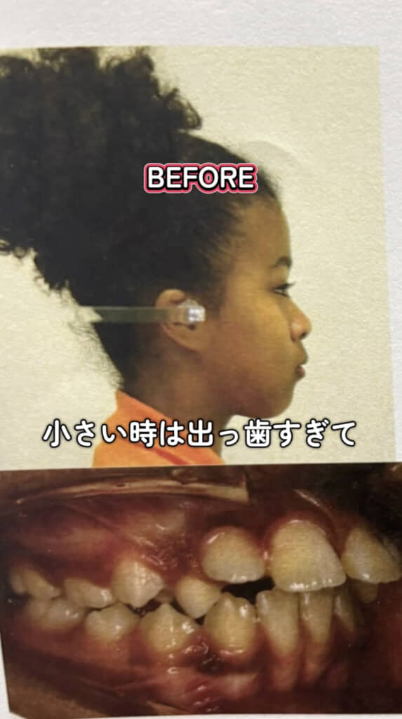 前歯が顔正面側に傾いています