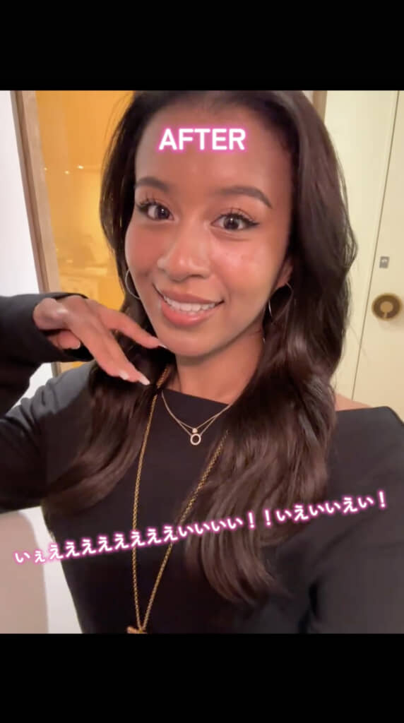 歯列矯正で歯並びがすっかりきれいに！