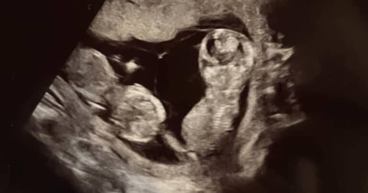 ママのお腹の中で寄り添う、双子の赤ちゃん→5年後……「うわぁ·····泣きそう」　姉妹の“現在の姿”に感動の声「たまらん」（1/2） | 育児 ねとらぼ