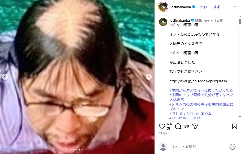 ロッチ中岡創一の頭皮