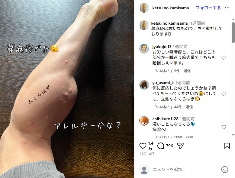 体中に蕁麻疹が出ていた樽美酒研二