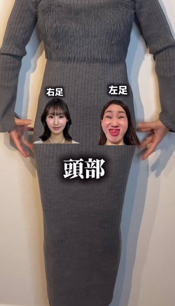 太ももの頭部がぽっこり