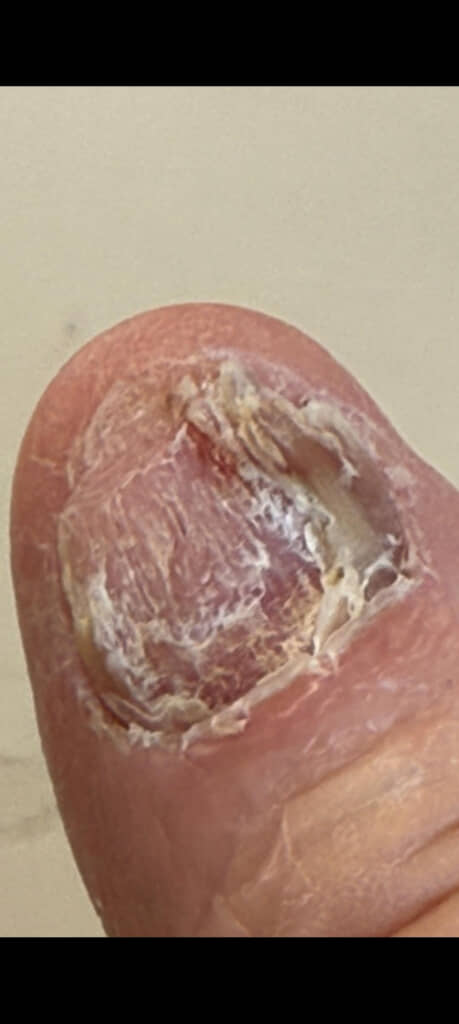 生えたりはがれたりを繰り返していた爪