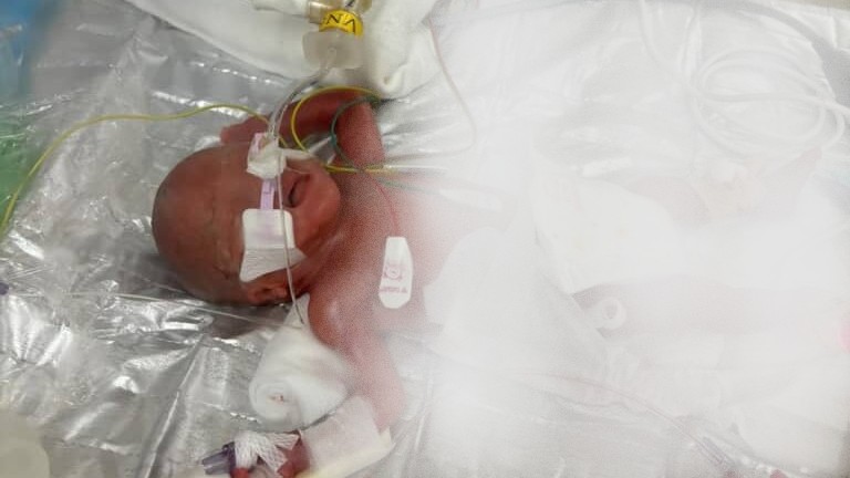 NICUに入院していた妹ちゃん