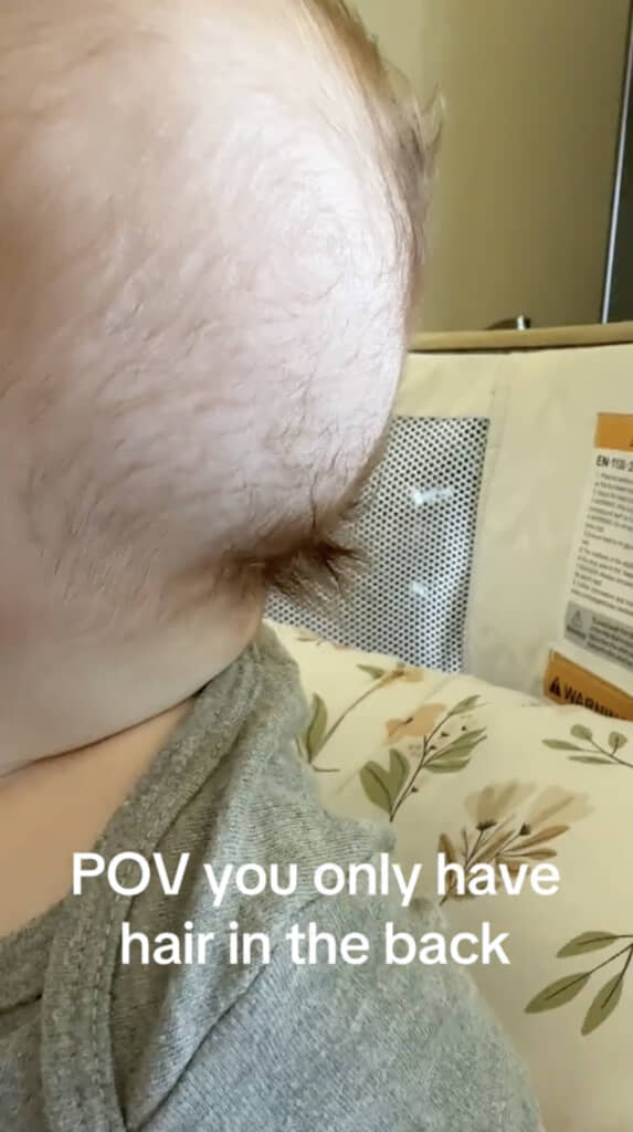 首のつけ根にだけふさふさの髪が！