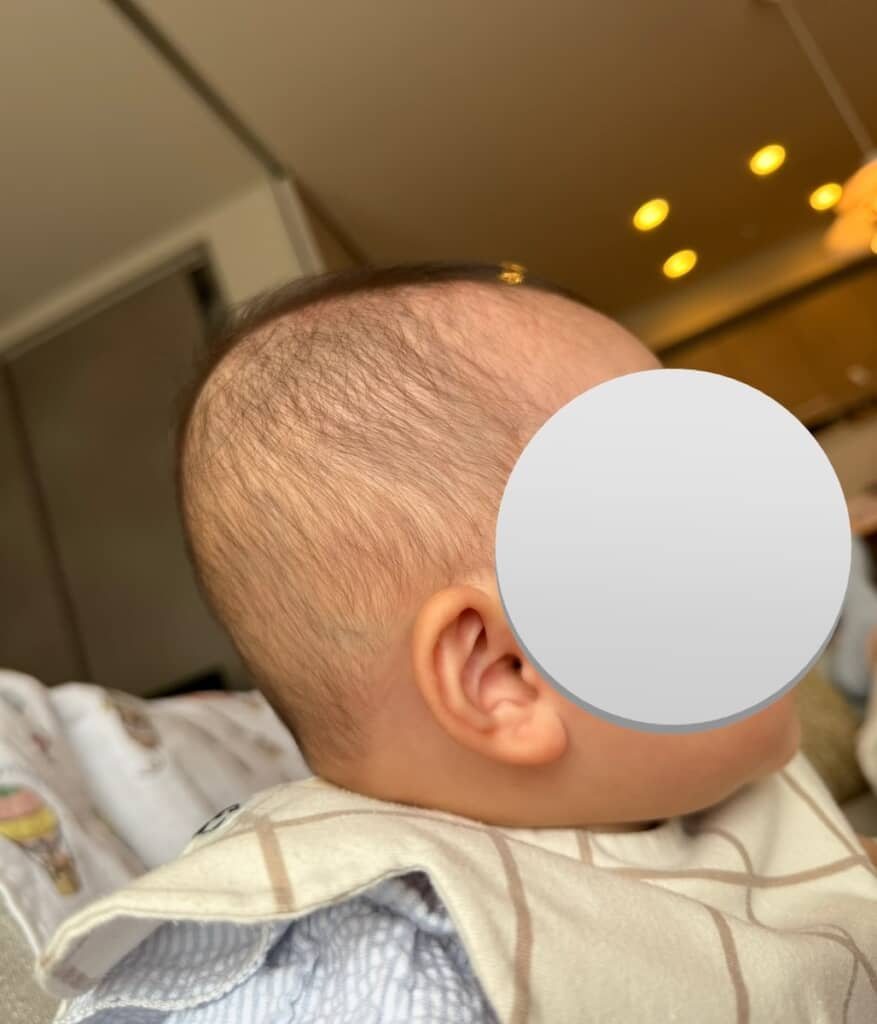 治療開始前の娘さん。横から見ると後頭部が平らな「短頭」の状態であることが分かります