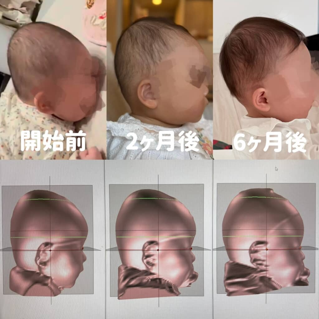 治療の経過。こうして見ると大きく頭の形が変わっていることが分かります