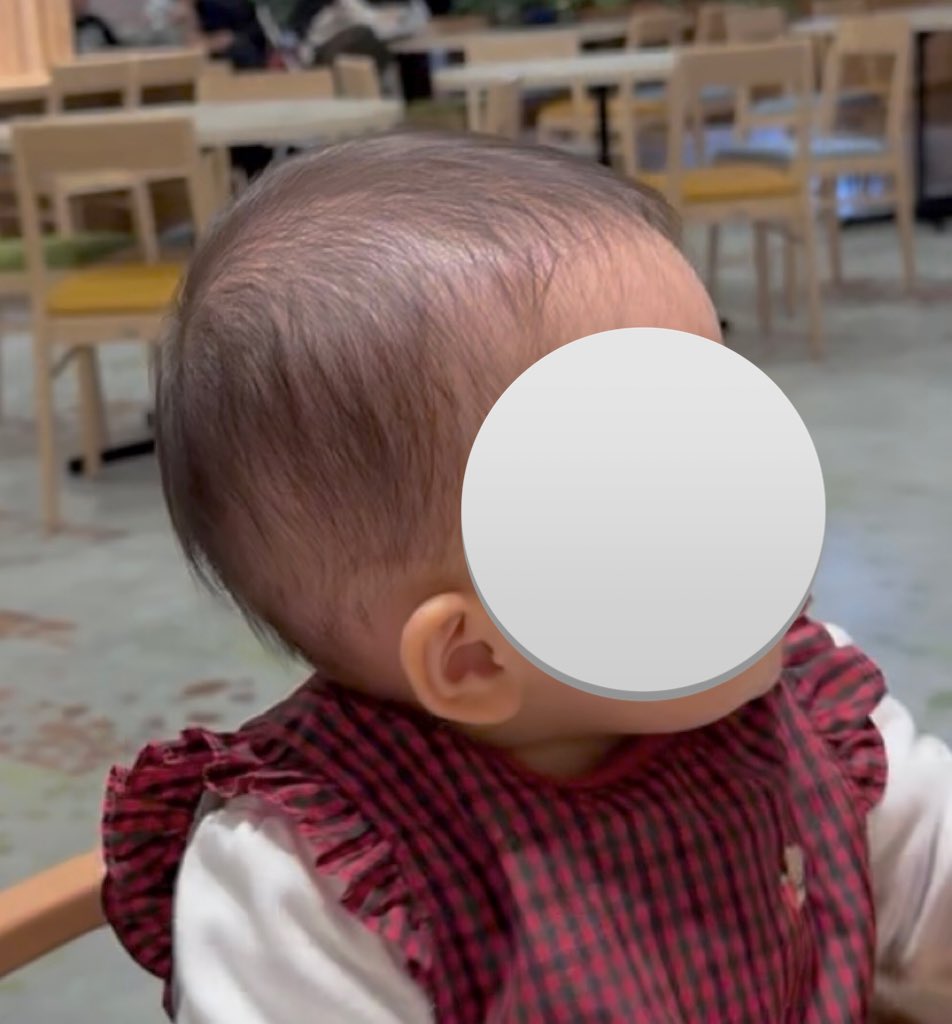 矯正の結果、美しい頭の形になりました！