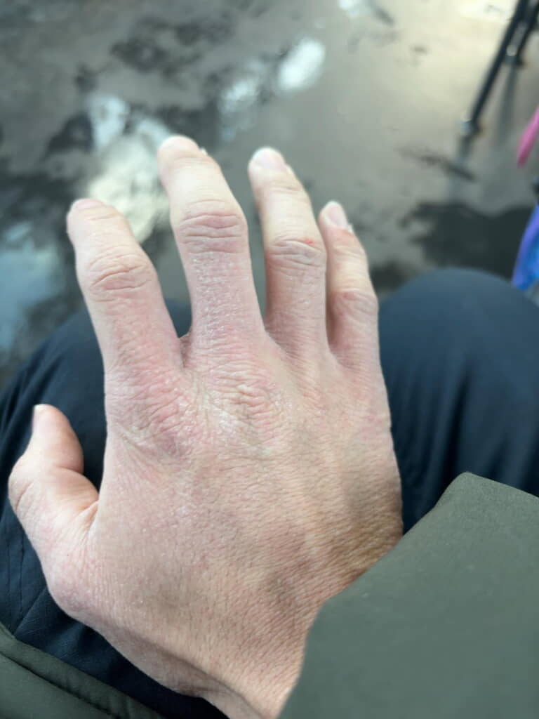 介護士の仕事の大変さがうかがえる手