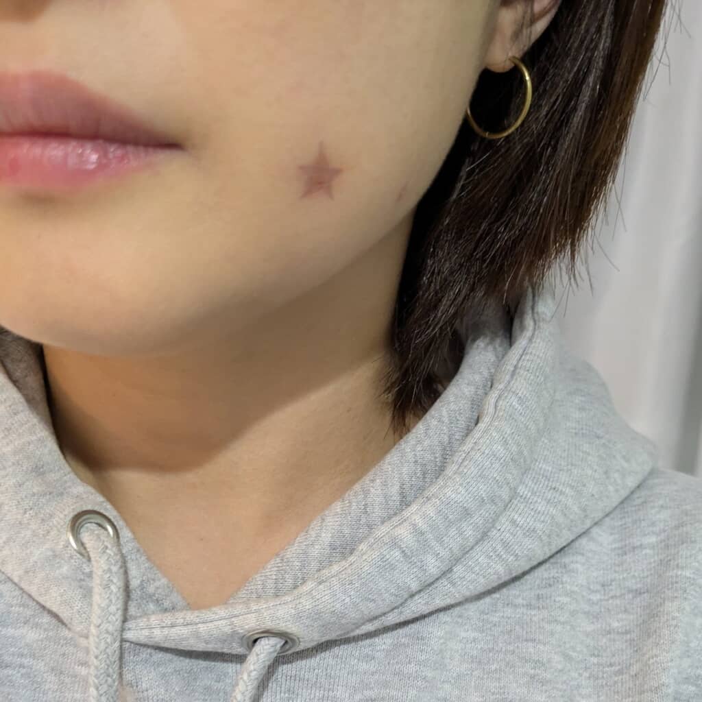 ニキビ跡の上から描いた星