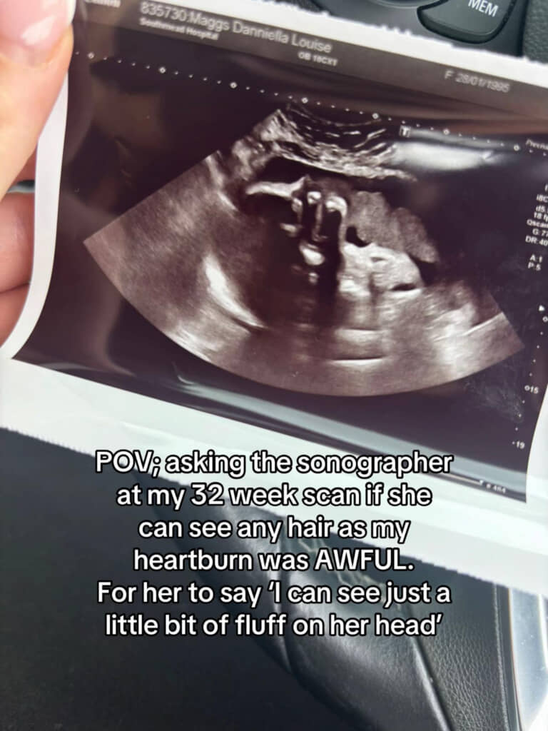 エコー検査では「多分髪の毛は少ない」と言われていた次女ちゃん