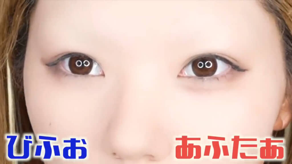 涙袋のビフォー（左）／アフター（右）