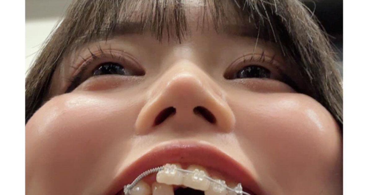 女性が“100万円の歯列矯正”に挑戦→たった1年で……「すげえ!!」 “衝撃のビフォアフ”が120万表示「こんなに……」(1/2) | 健康・筋トレ ねとらぼ