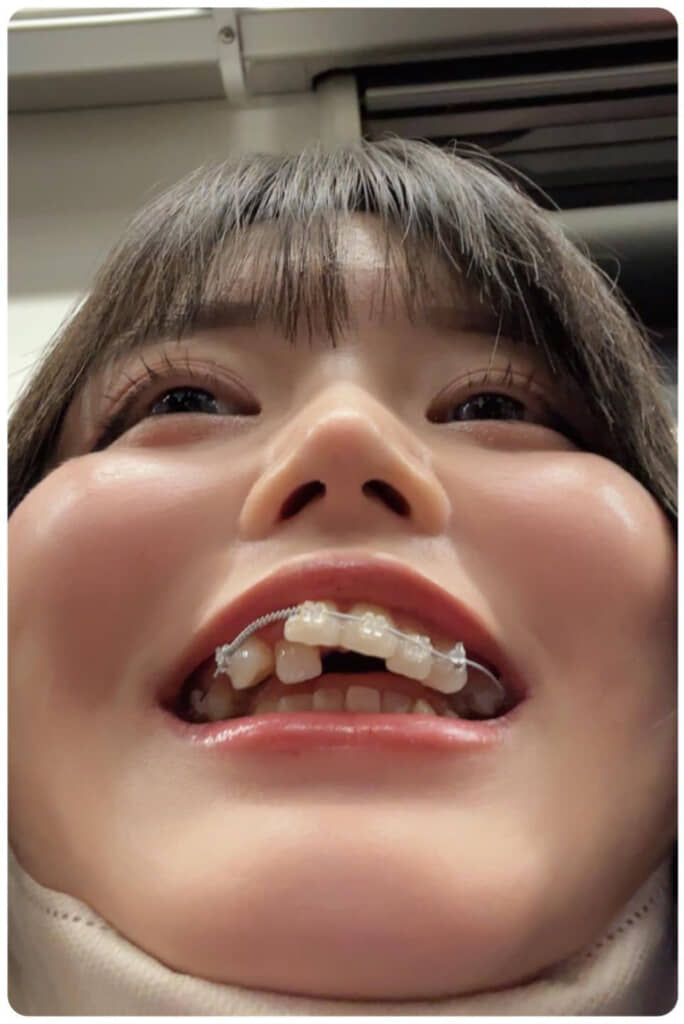 歯列矯正を始めたころの投稿者さん