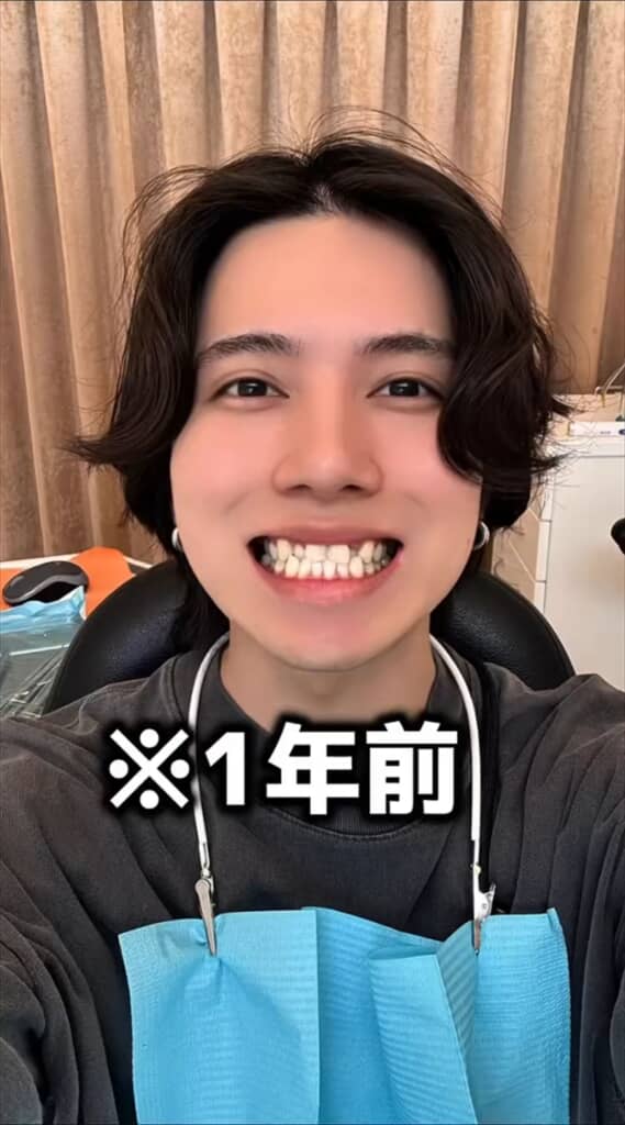 「がんこちゃん」と呼ばれた男性の歯列矯正