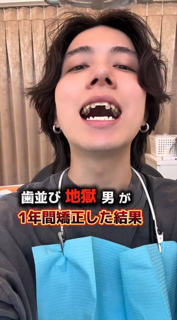 「がんこちゃん」と呼ばれた男性の歯列矯正