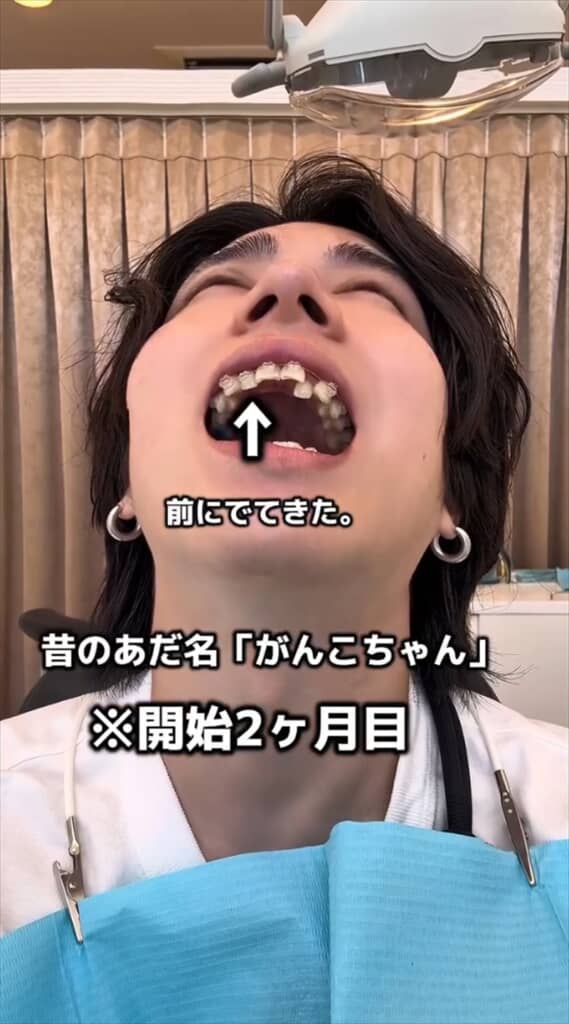 「がんこちゃん」と呼ばれた男性の歯列矯正