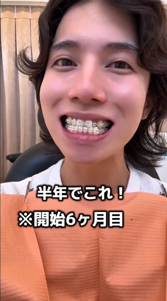 「がんこちゃん」と呼ばれた男性の歯列矯正