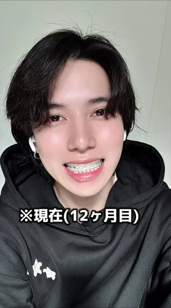 「がんこちゃん」と呼ばれた男性の歯列矯正