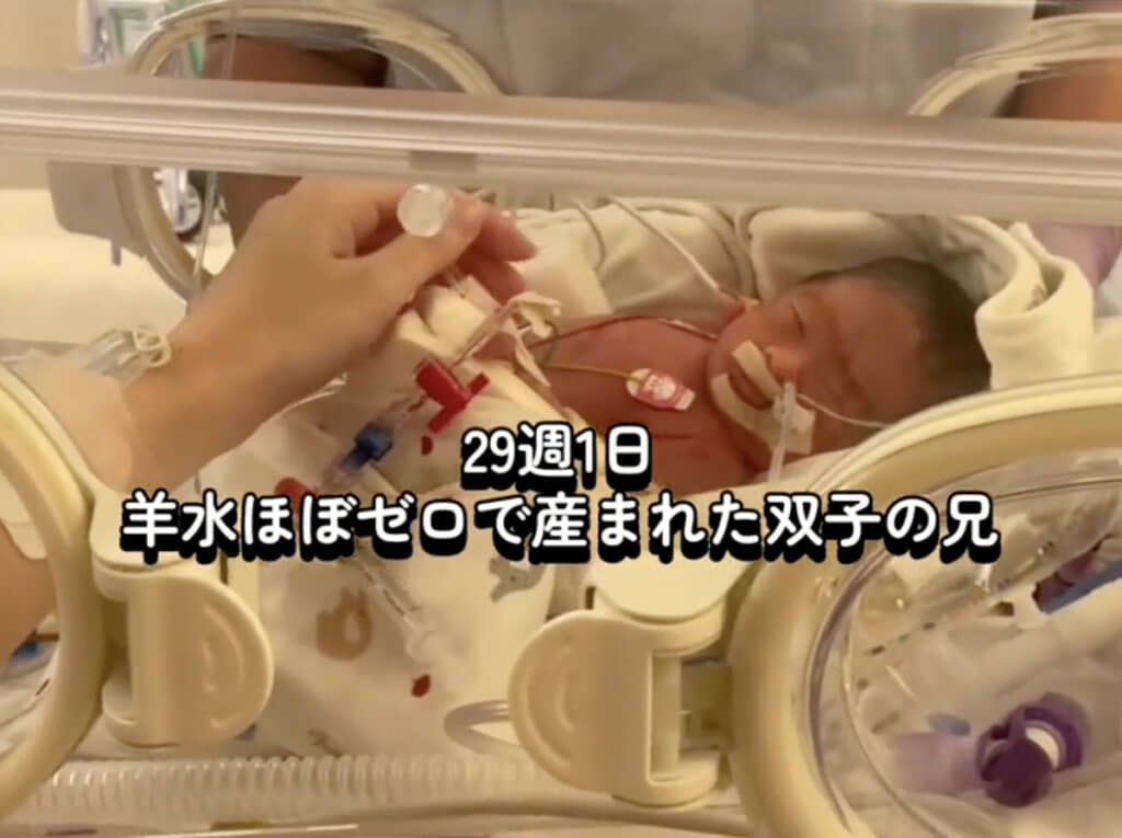 医師に「生存が難しい」と言われていた双子の兄