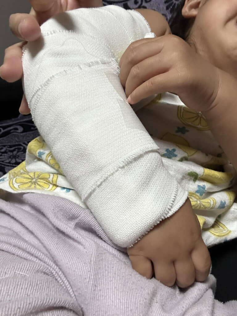 骨折してしまった幼い娘さん。ギプスで固めた右腕が痛々しい……