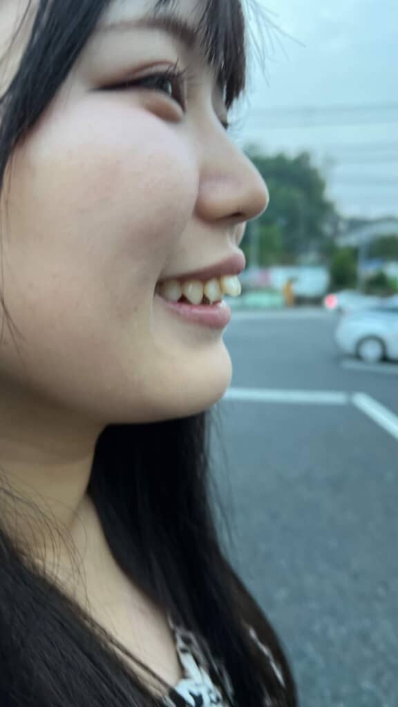 矯正を始める前のにんにくさん
