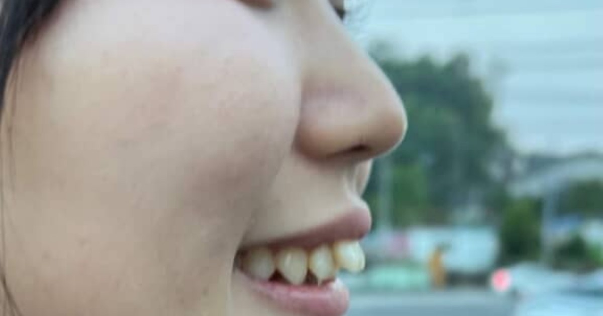 女性が“100万円の歯列矯正”に挑戦→1年後……「すごーい!」 驚きの変化に「同じ人?」「びっくり!」(1/2) | ライフスタイル ねとらぼ