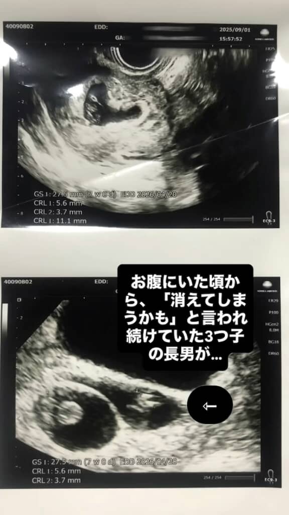 おなかの中にいたころから、ひときわ小さかった息子くん