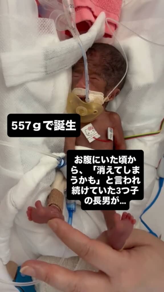 体重557グラムで誕生
