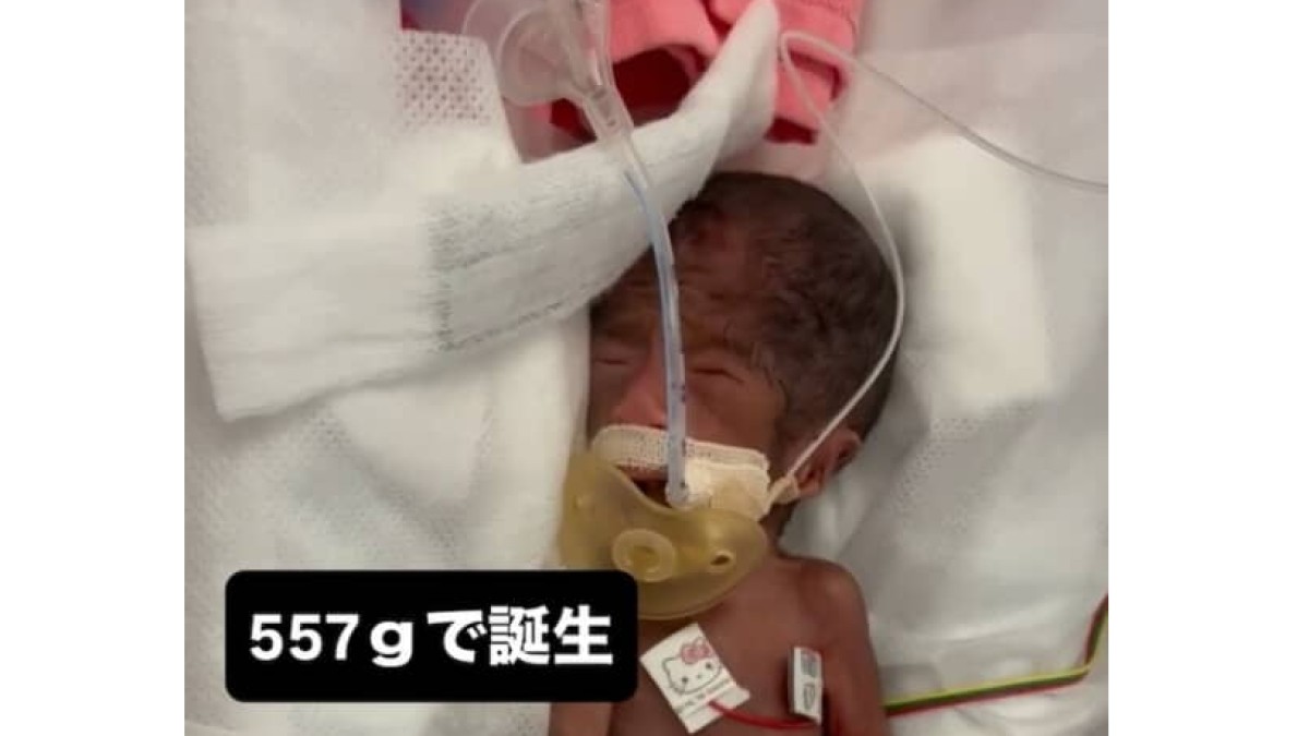 妊娠中、「消えてしまうかも」と言われた三つ子長男→557グラムで誕生し…… 4カ月後の“現在の姿”に「生命力って凄い」「応援してます」(1/2) | 育児 ねとらぼ