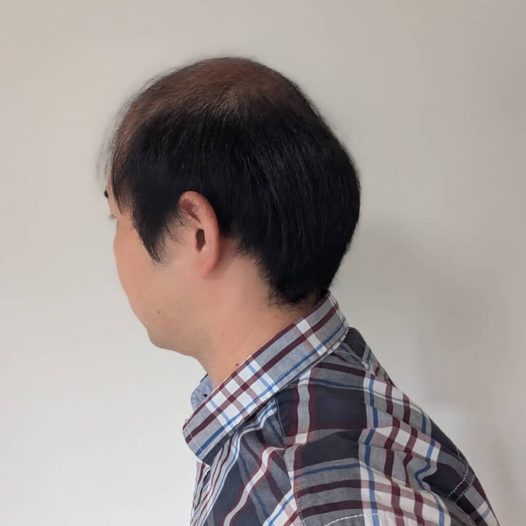 サイドと後頭部のみ髪が残っていました
