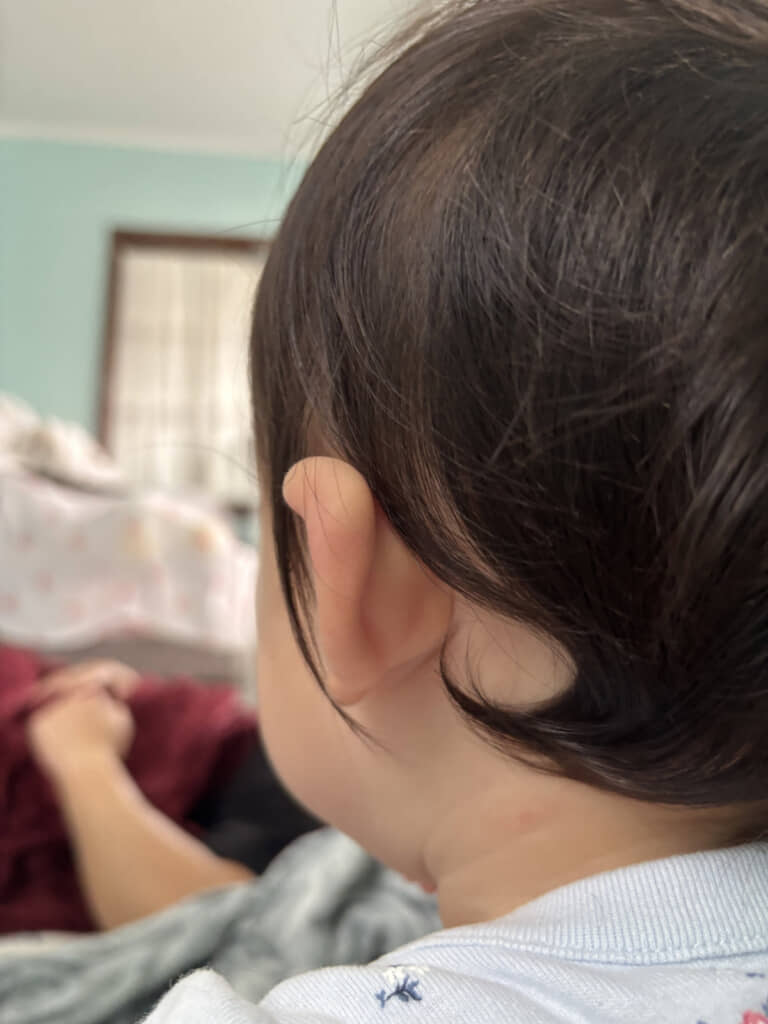 1歳の娘さんのえり足のクセを不思議に思っていたら……